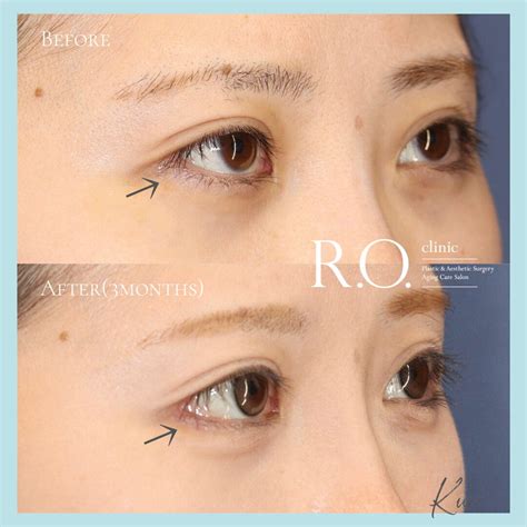 roclinic