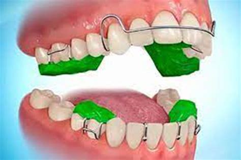 myofunctional appliance  dental clinic  coimbatore tooth town