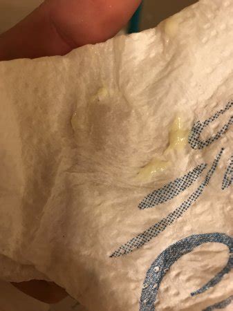 Yellow Clumpy Discharge