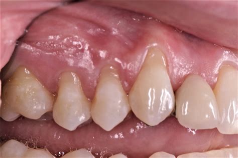 soft tissue defects cases  questions osseonews