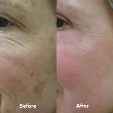 Skin Tightening- Now 30% Off| Reduce Wrinkles | Tighten Loose Body Skin