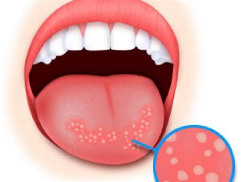 Symptoms and treatment of glossitis in adults | Health