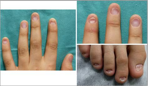 Abnormal Fingernails