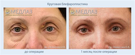 Блефаропластика до и после: фото результатов в клинике МедЛаз