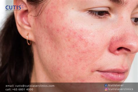Do You Have Tiny Bumps on Your Face?
