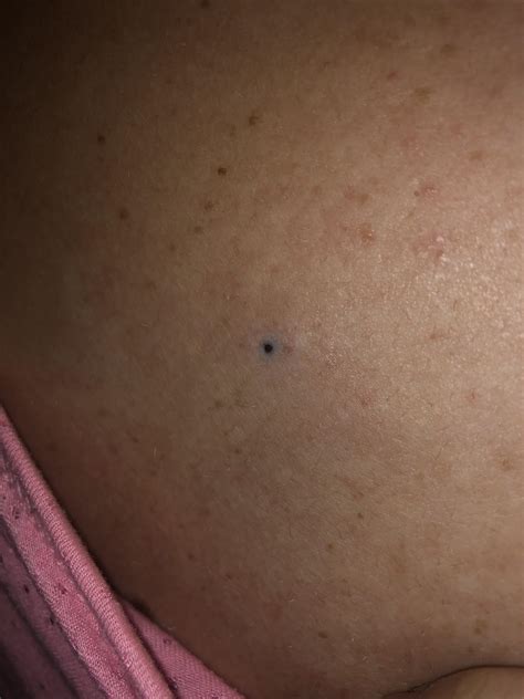 For my cake day here’s my mom’s giant blackhead. No pop yet. : r/popping
