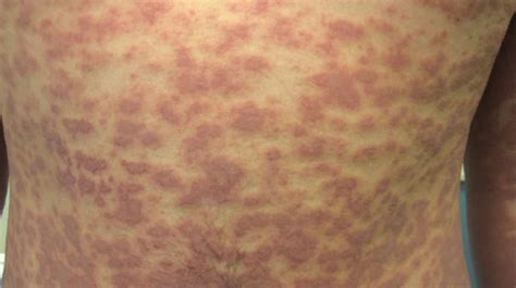 Common Skin Rashes | informacionpublica.svet.gob.gt