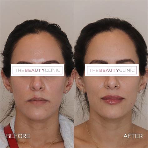 Before and After: Lip Filler – The Beauty Clinic