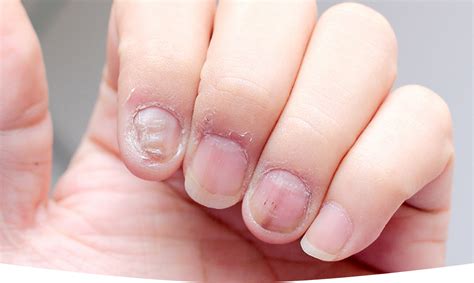 The Most Common Causes of Nail Fungus - Celebblink