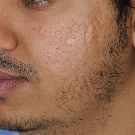 Acne Scar Treatment Before After Photos Seattle Bellevue