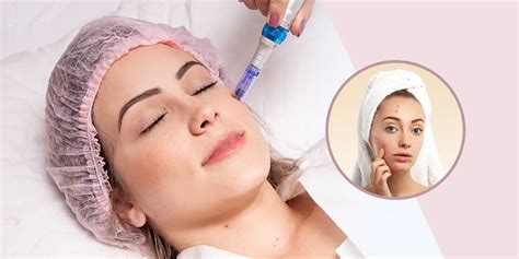 Dealing with Acne Scars? Here’s How Dermapen Microneedling Can Help ...