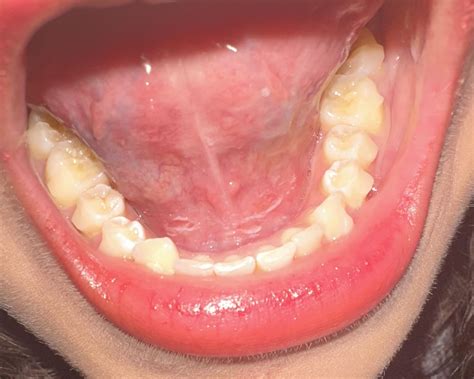 tongue cancer close   cancer   tongue stock image