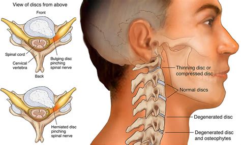 Radiculopathy: Symptoms, Causes Treatment, 53% OFF