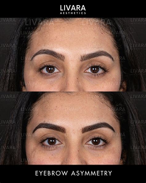 how to fix eyebrow asymmetry