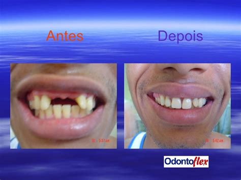 Protese Flexivel Antes E Depois