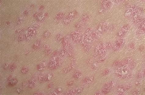 Psoriáza - příčiny, příznaky, léčba