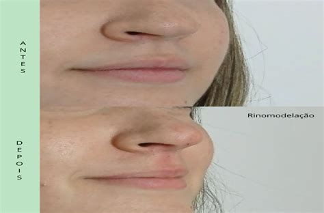 Harmonização Intima Antes E Depois - Dra. Camila Capeli | Harmonização Íntima Masculina e Feminina ...