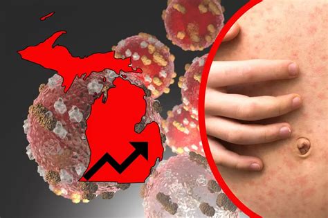 CDC Warns of Deadly Measles Virus Now in Michigan