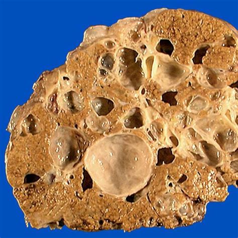 AD Polycystic Liver Disease | Clinical Gate