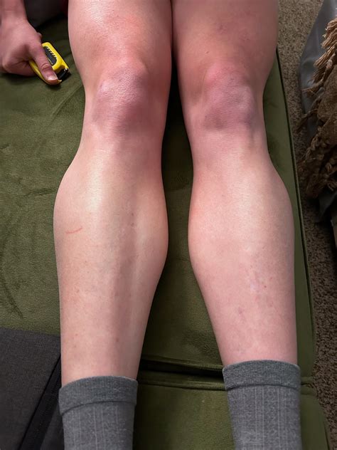 One sided calf pain and swelling? Hips, neck and back hurt too. What