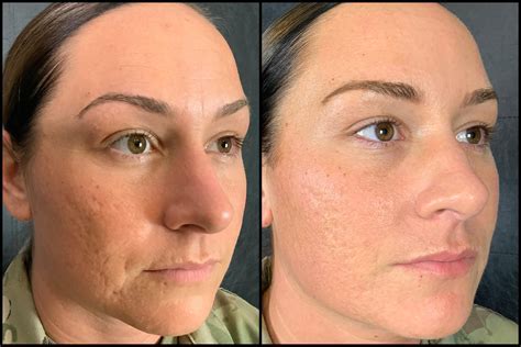 Images Of Microneedling Before And After | Microneedling