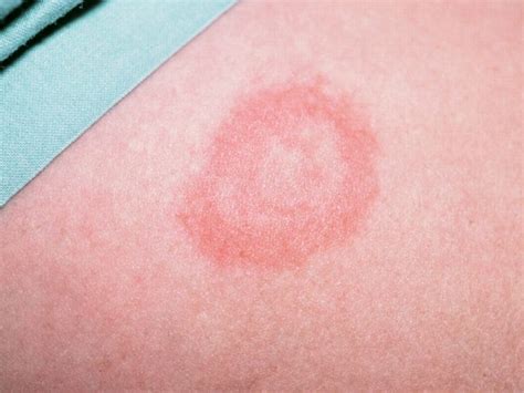 Bệnh Lyme: nguyên nhân, triệu chứng và cách điều trị • Hello Bacsi