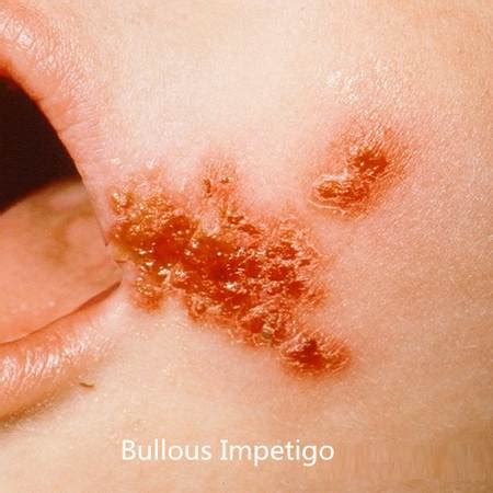 infantigo pictures  prevention  treatment