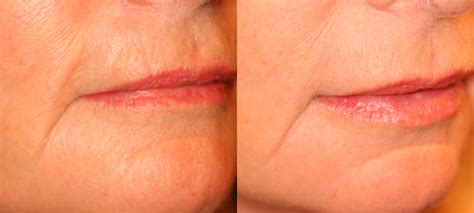 Belotero Treatments in El Dorado Hills CA