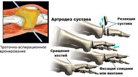 Гнойный бурсит - презентация онлайн