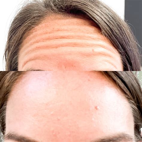 Stitched Image Before & After (1 Picture) - Premier Women's Health