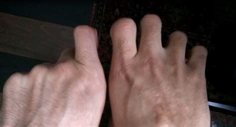 Palm MCP Joint Getting Worse, Swollen PIP Joint, Doctors and ...