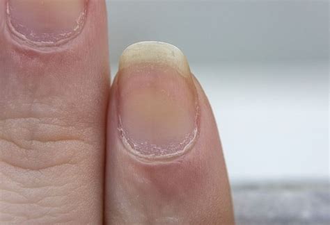 Discolored nails can be a sign of these hidden health issues