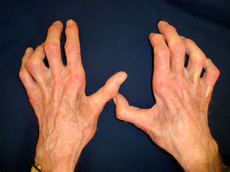 Ulnar Nerve Entrapment