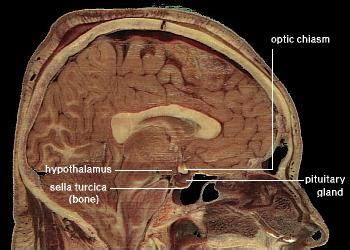 Gelastic seizure - Wikipedia