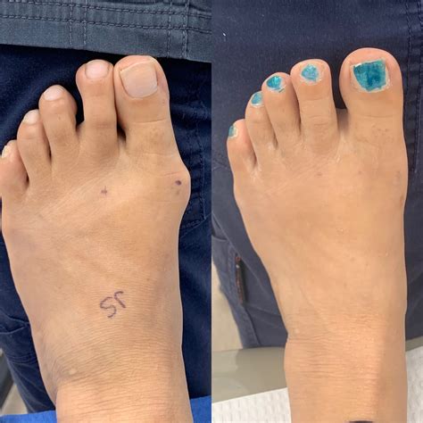 Before and After Bunion Surgery Photos | The Bunion Cure