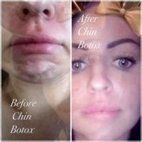 Botox On Chin Before And After » Facial Injections: Info, Prices ...