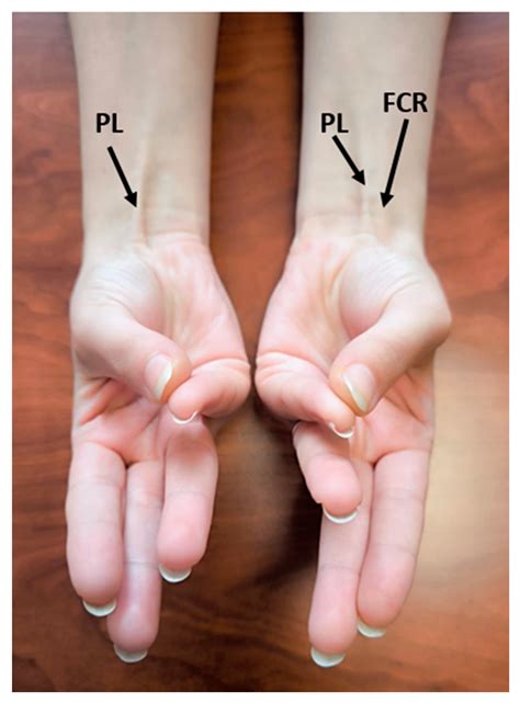 Investigation of the Effect of Palmaris Longus Presence on the Upper