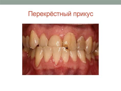 Прикусы. Виды патологических прикусов - презентация онлайн