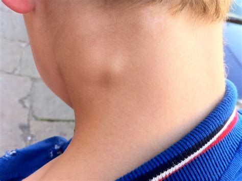 Why Is There A Knot On The Side Of My Neck at Michael Earl blog