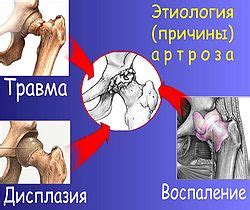 Деформирующий артроз | это... Что такое Деформирующий артроз?