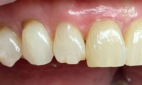 Repair of a chipped tooth Before & After Photos | Austin TX