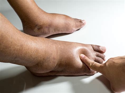 The Meaning Of Swollen Leg at Gordon Adams blog