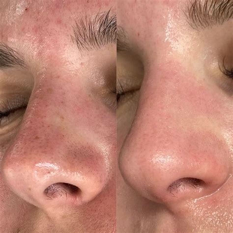 This Unbelievable Blackhead Removal 2024 Trick Changed My Life! (See My Results) Image 19