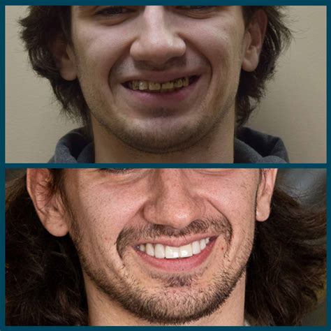 Full Mouth Restoration in Edmonton, AB | Davinci Smiles