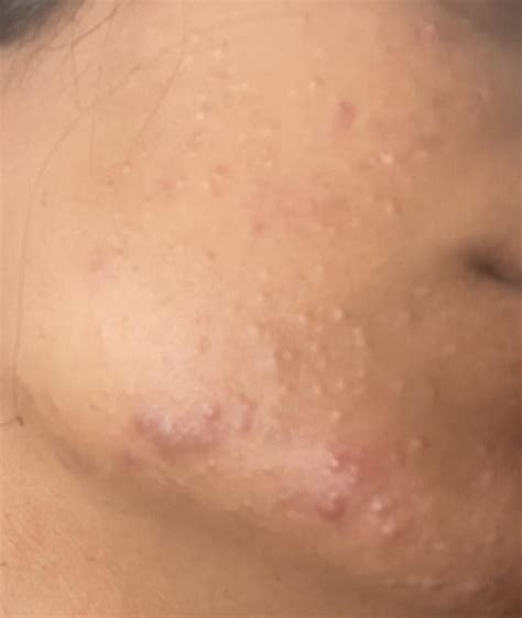 ive   arazlo   improvements rplusskincare