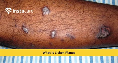 Lichen Planus: Symptoms, Causes, Treatment, and More.