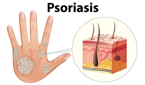 Know the 10 complications of psoriasis | Dr Batra’s®