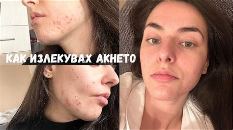 СПРАВИХ СЕ С АКНЕТО!!! Skincare, Антибиотик, Процедури, Храна и Колко ...