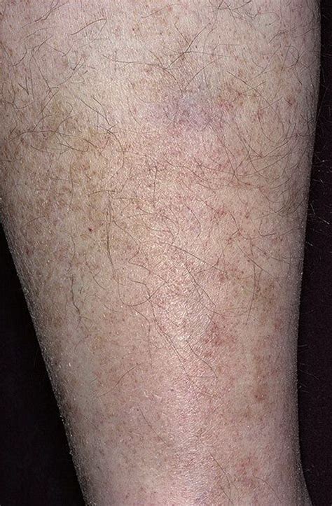 Варикозная экзема фото – 174 шт. / fotodiagnoz.com