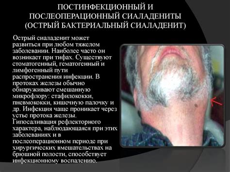 Острые и хронические заболевание слюнных желез - презентация онлайн